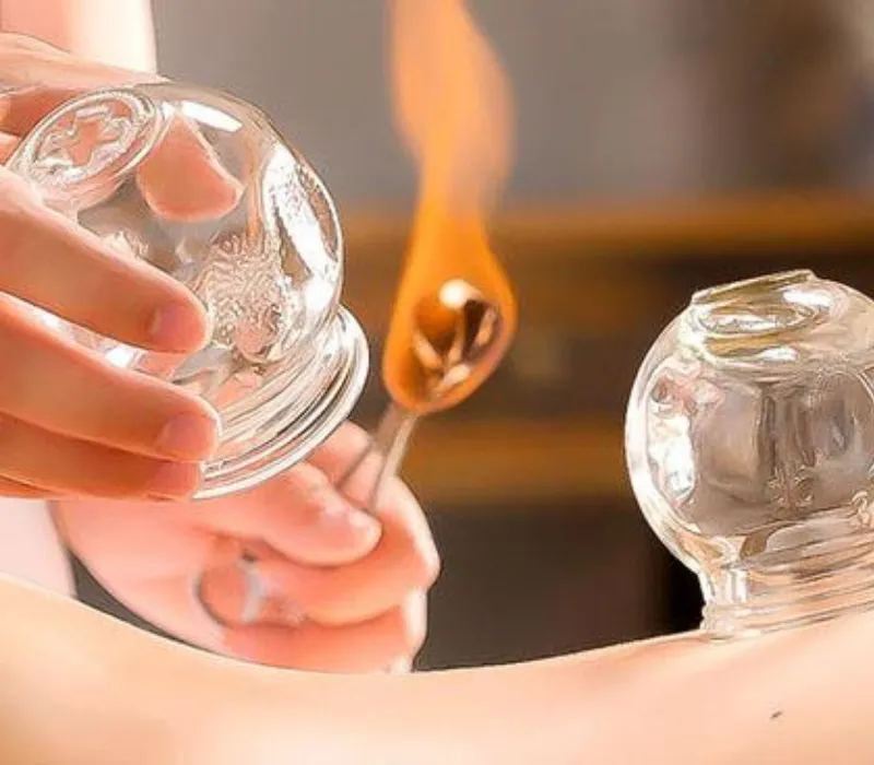 Dry Cupping Therapy in Huddersfield — traditional cupping therapy to ease muscular tension and promote relaxation.